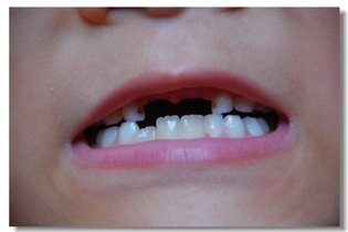 2,对"邻牙"健康有害 缺牙空隙两侧的牙