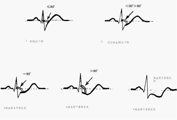 劳损心电图图片